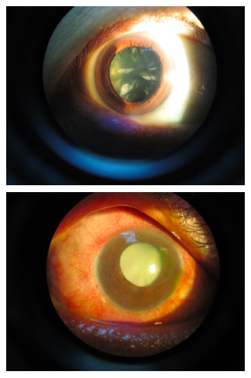 Cataract eye treatment Malaysia