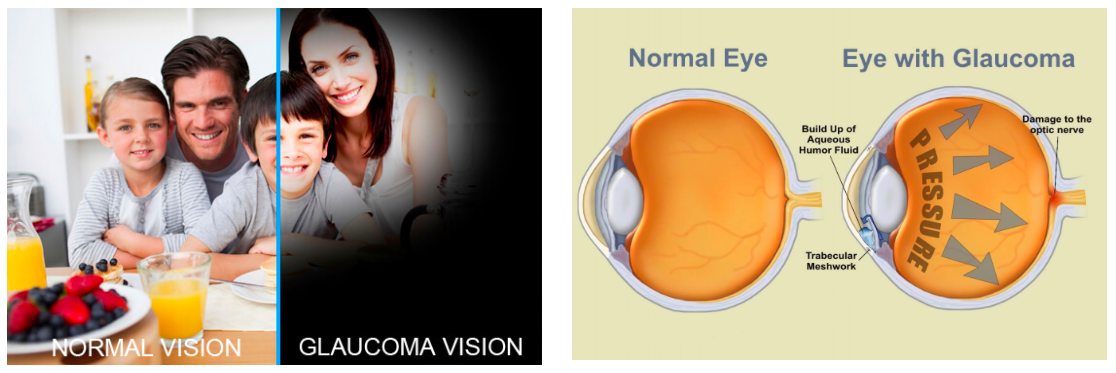 Glaucoma Surgery Malaysia