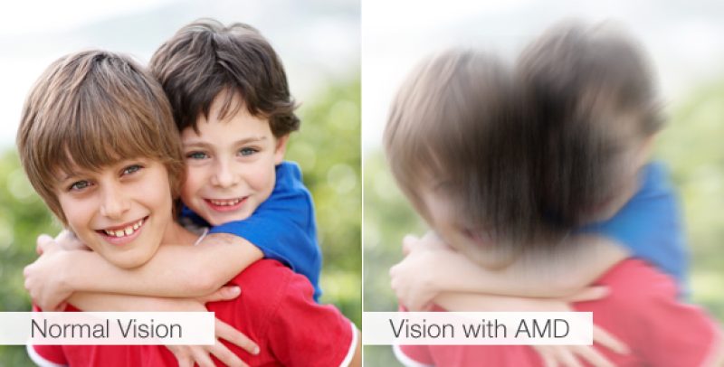 Age-Related-Macular-Degeneration2