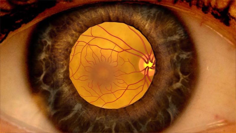 Diabetic Retinopathy
