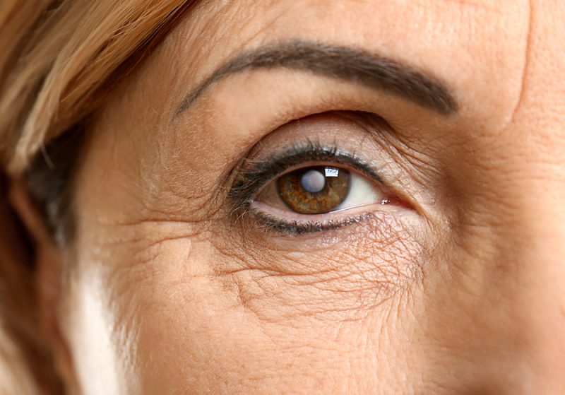cataract (2)