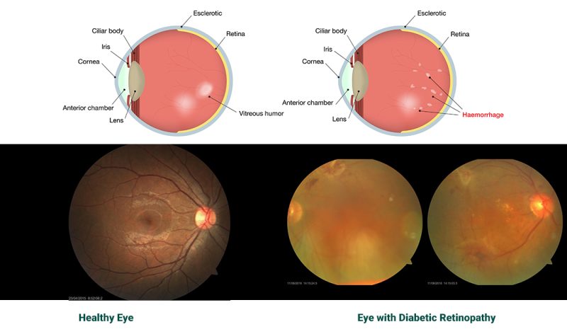 eye-diabetic-retinopathy-2018